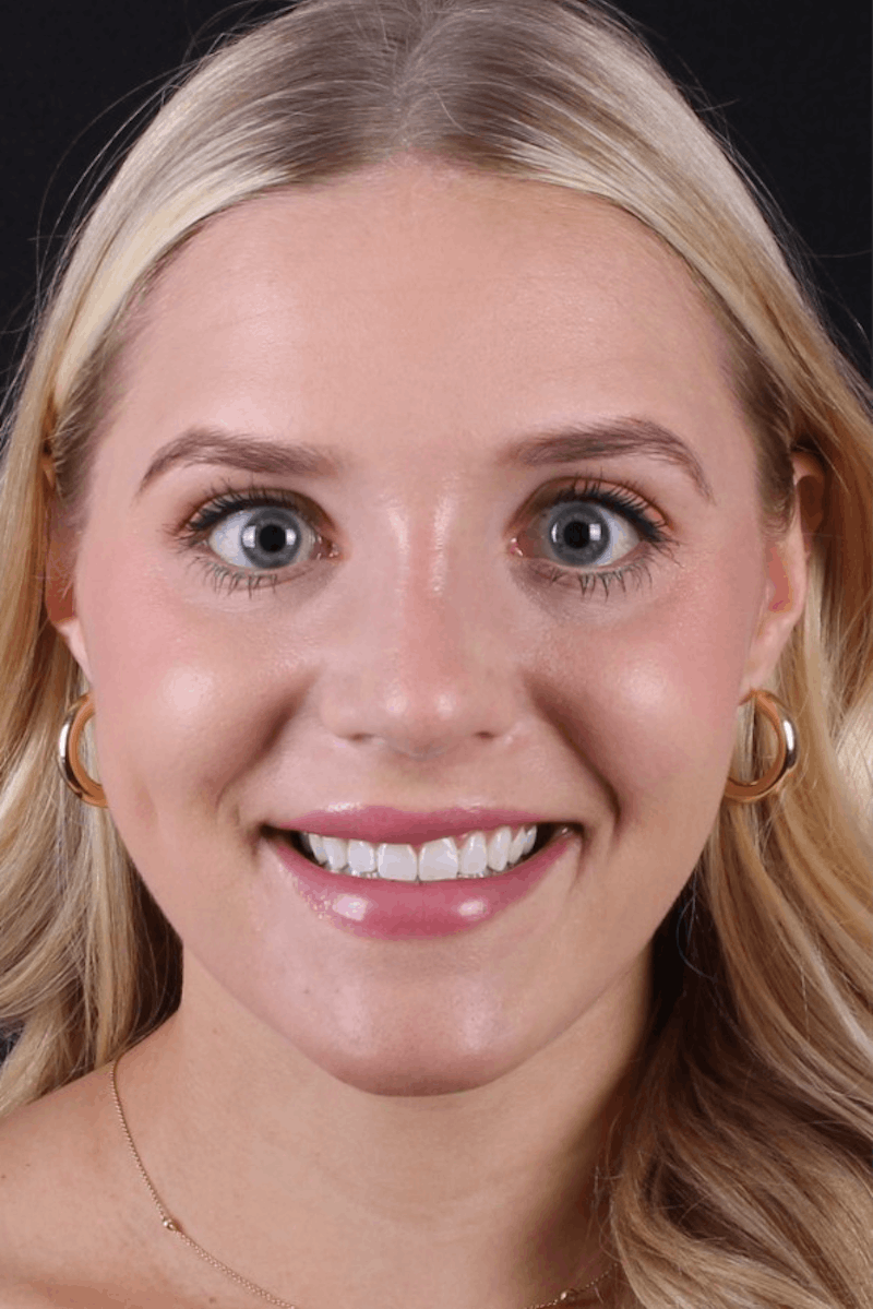 Rhinoplasty Female Before & After Gallery - Patient 428250 - Image 4