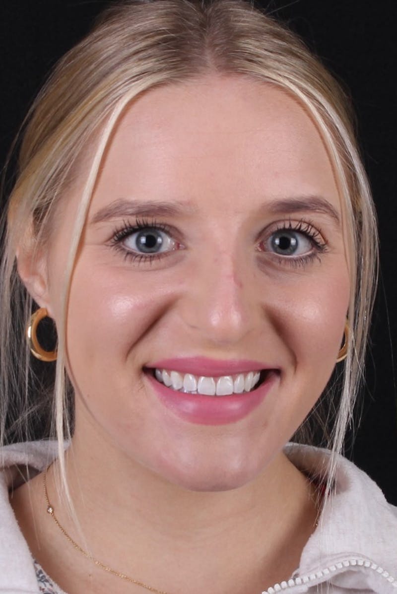Rhinoplasty Female Before & After Gallery - Patient 428250 - Image 3