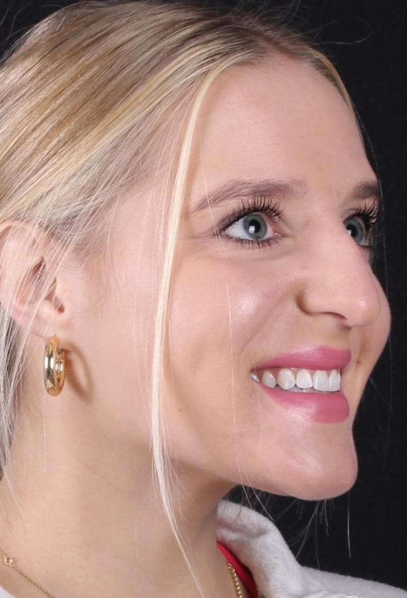 Rhinoplasty Female Before & After Gallery - Patient 428250 - Image 9