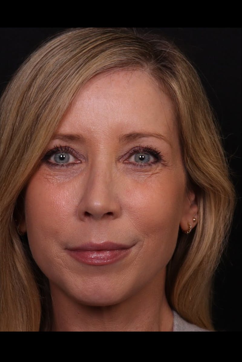 Rhinoplasty Female Before & After Gallery - Patient 350471 - Image 4