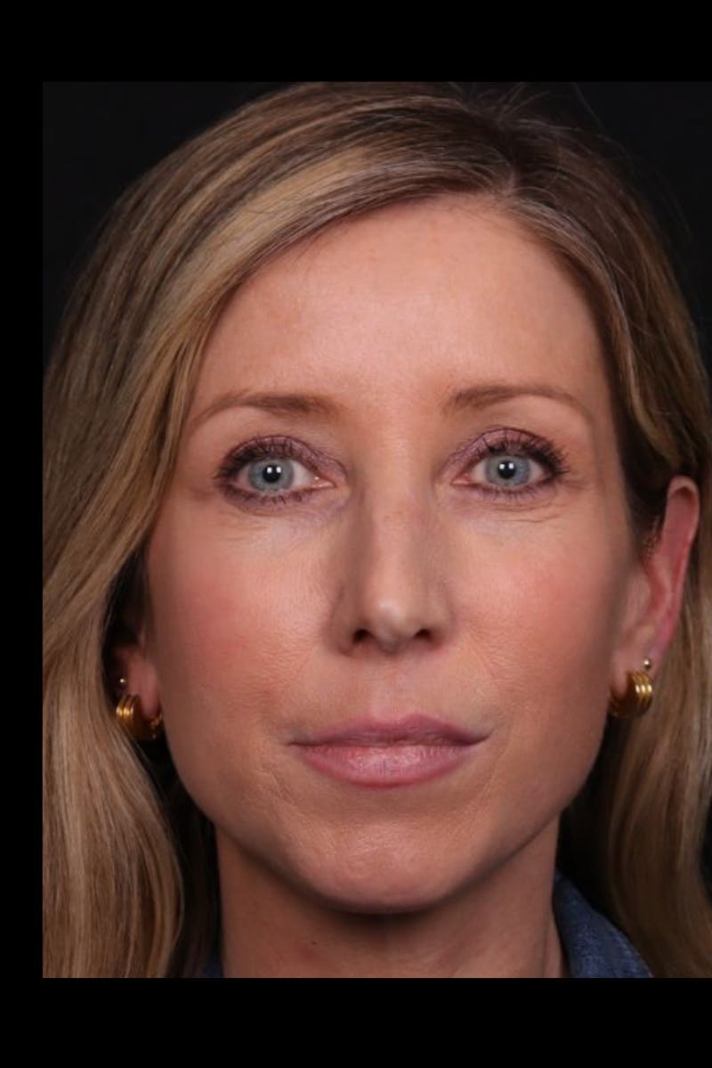 Rhinoplasty Female Before & After Gallery - Patient 350471 - Image 3