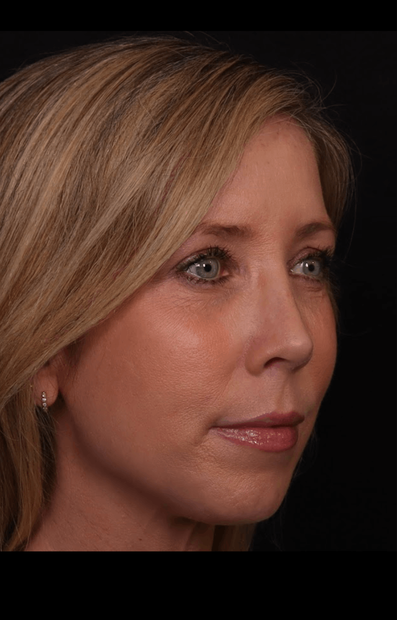 Rhinoplasty Female Before & After Gallery - Patient 350471 - Image 6