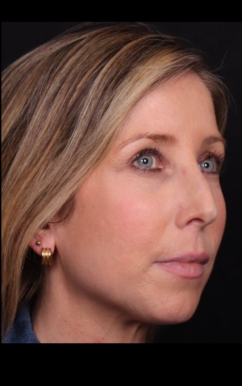 Rhinoplasty Female Before & After Gallery - Patient 350471 - Image 5