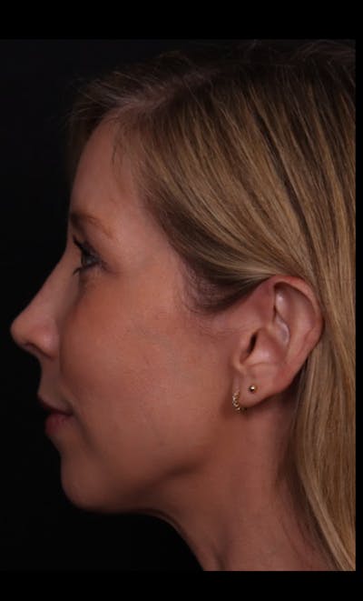 Rhinoplasty Female Before & After Gallery - Patient 350471 - Image 2