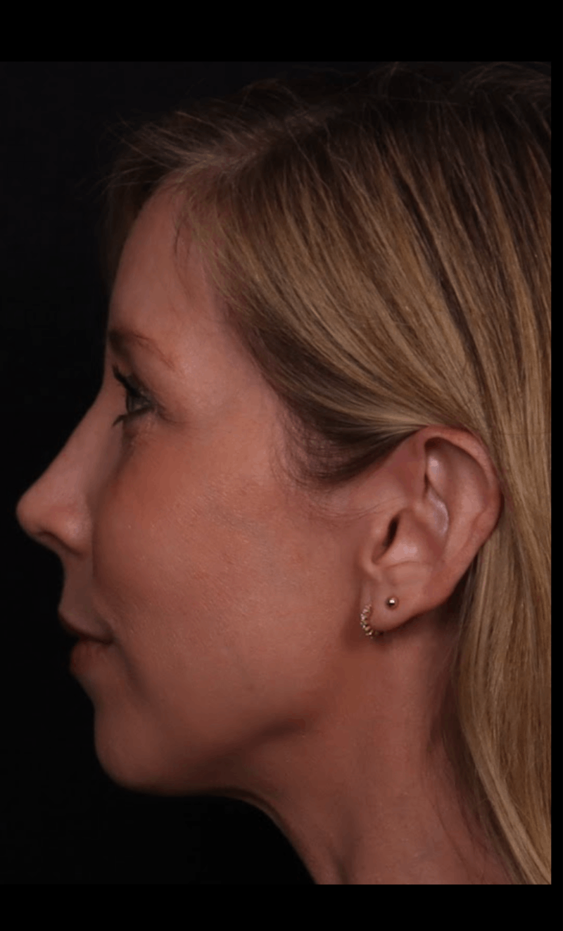 Rhinoplasty Female Before & After Gallery - Patient 350471 - Image 2