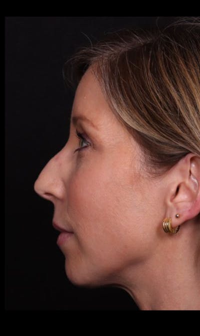 Rhinoplasty Female Before & After Gallery - Patient 350471 - Image 1