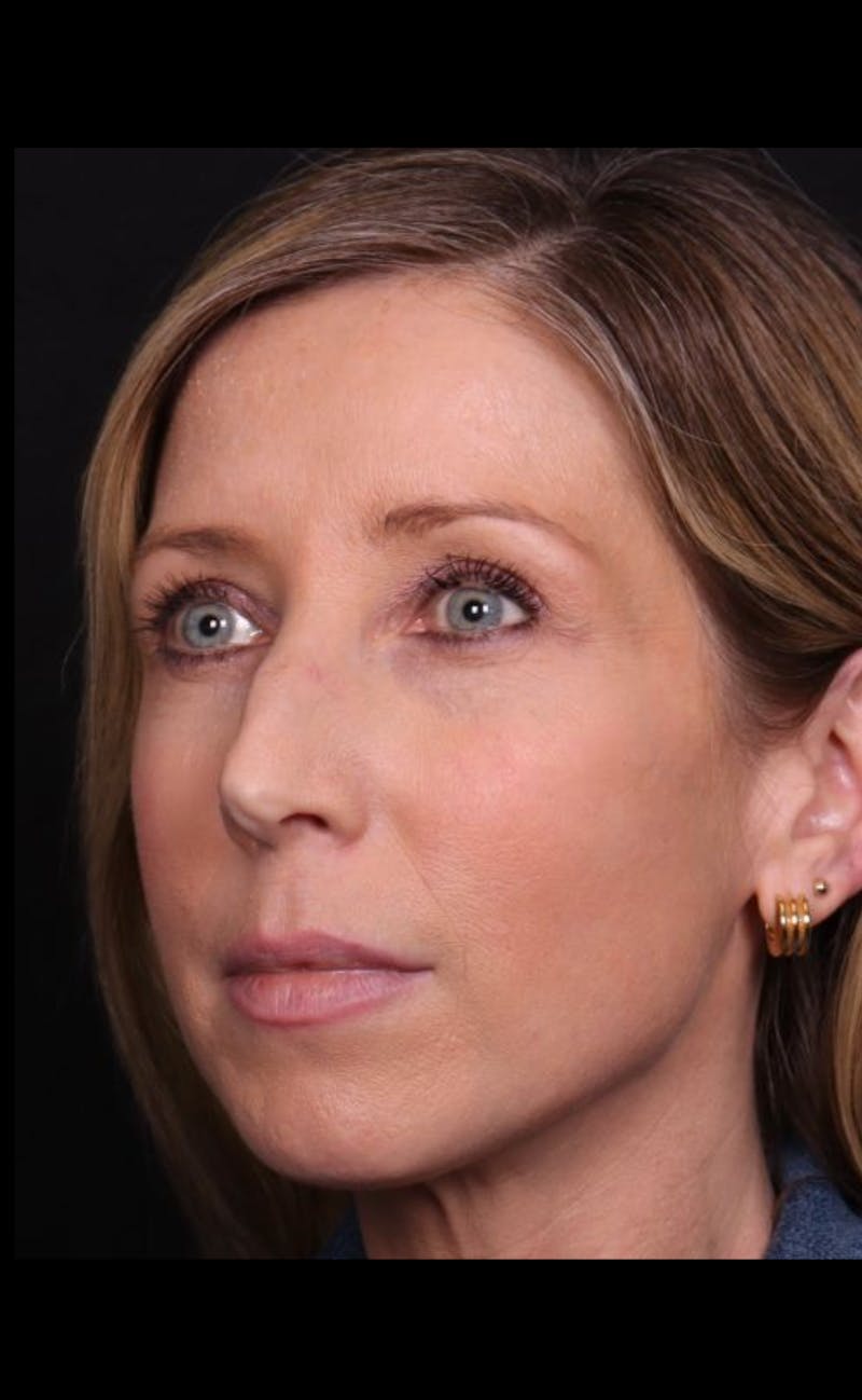 Rhinoplasty Female Before & After Gallery - Patient 350471 - Image 7