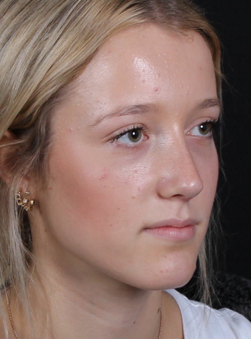 Rhinoplasty Female Before & After Gallery - Patient 938462 - Image 6