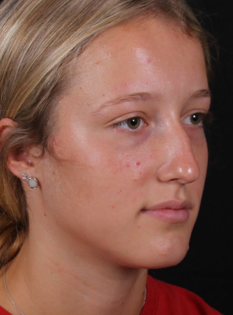 Rhinoplasty Female Before & After Gallery - Patient 938462 - Image 5