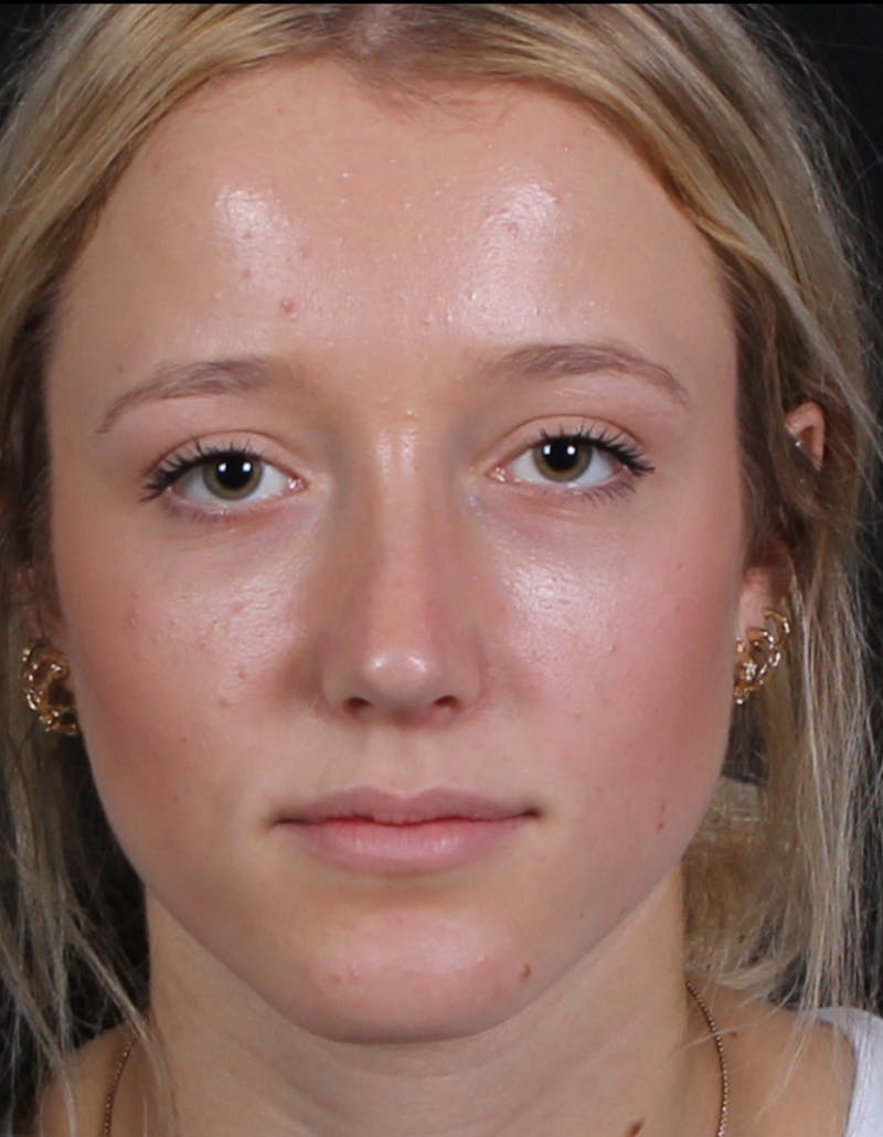 Rhinoplasty Female Before & After Gallery - Patient 938462 - Image 4