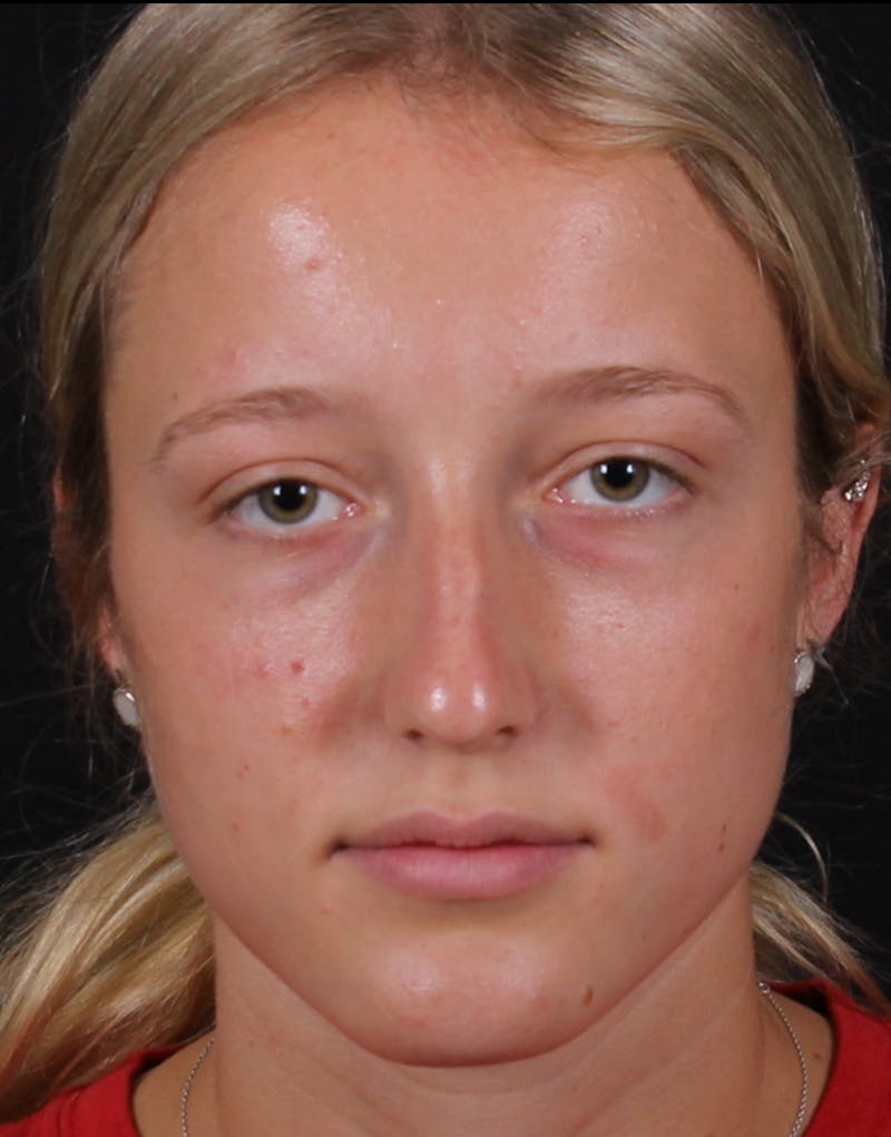 Rhinoplasty Female Before & After Gallery - Patient 938462 - Image 3