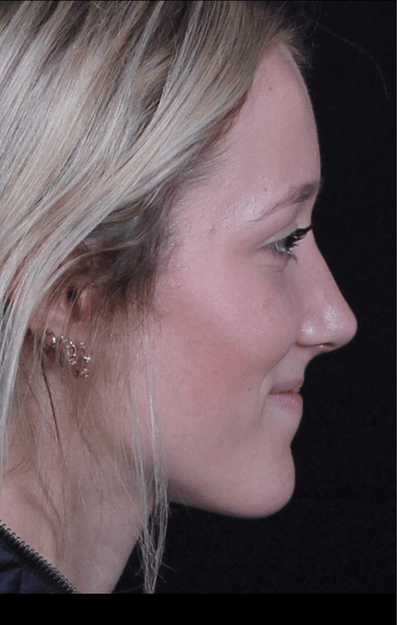 Rhinoplasty Female Before & After Gallery - Patient 938462 - Image 8