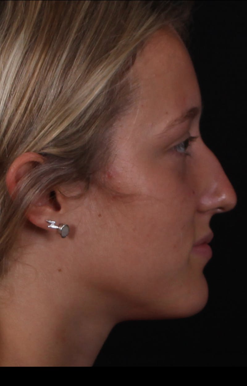 Rhinoplasty Female Before & After Gallery - Patient 938462 - Image 7
