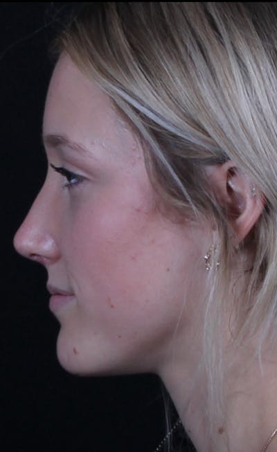 Rhinoplasty Female Before & After Gallery - Patient 938462 - Image 2