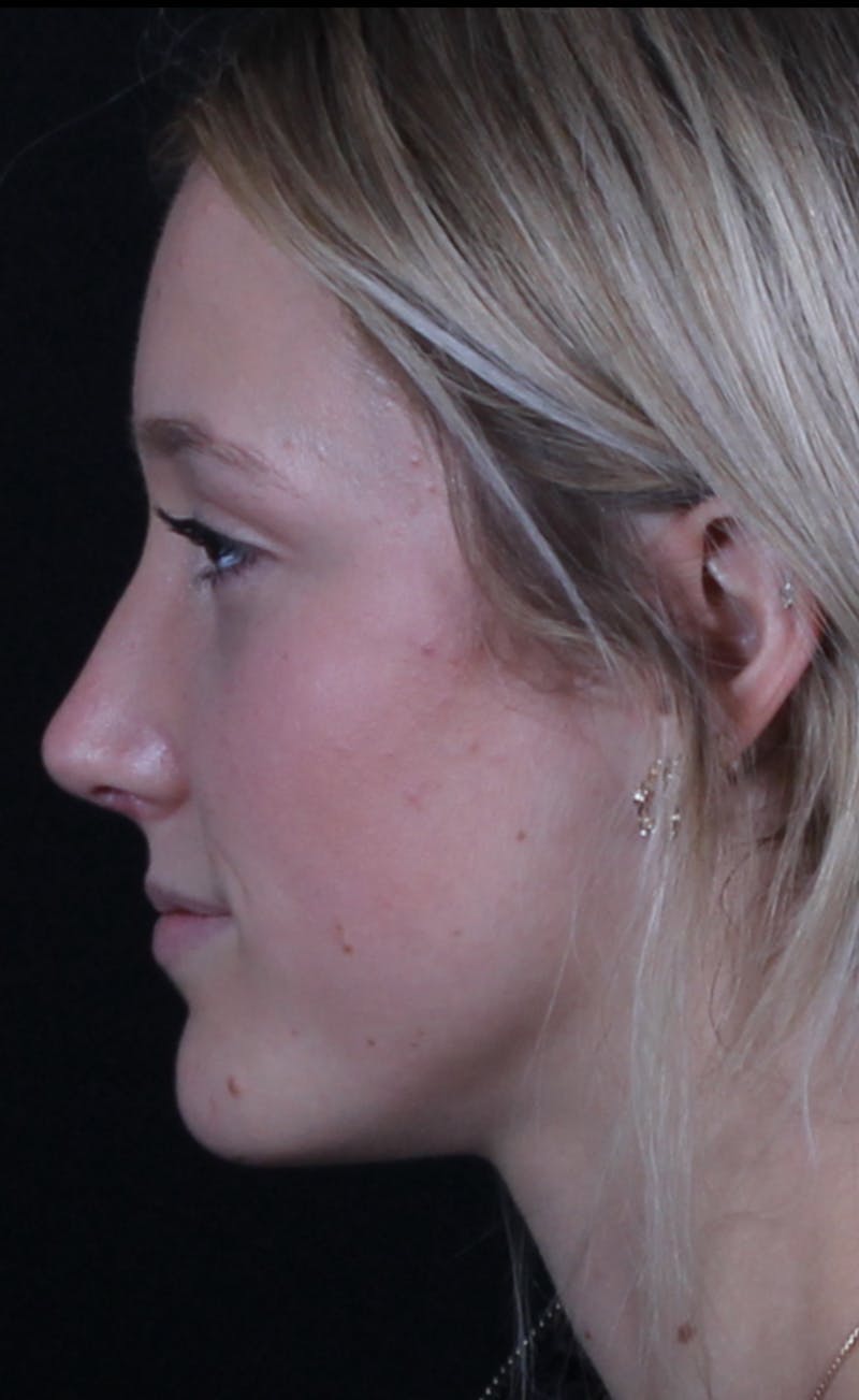 Rhinoplasty Female Before & After Gallery - Patient 938462 - Image 2