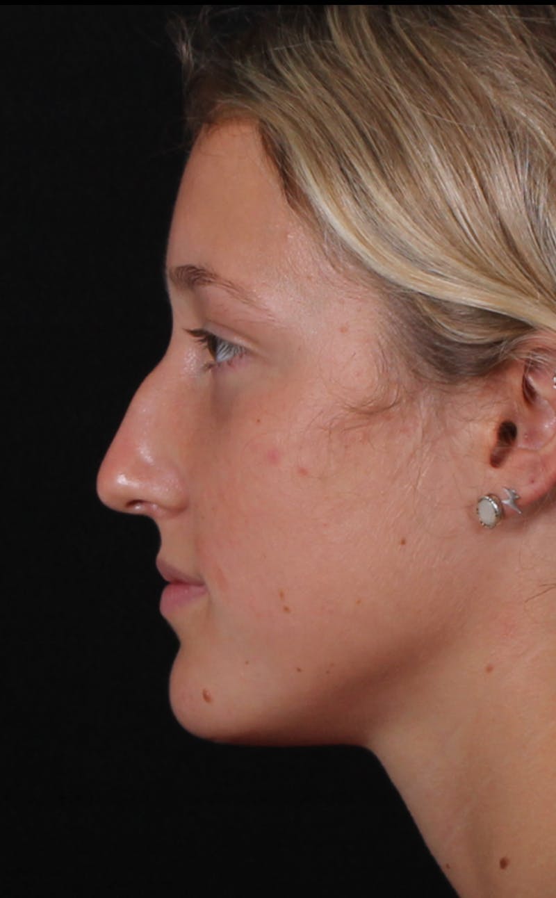 Rhinoplasty Female Before & After Gallery - Patient 938462 - Image 1