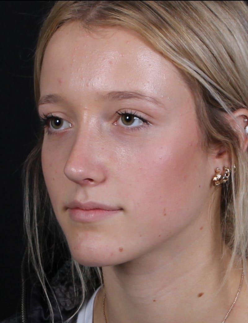 Rhinoplasty Female Before & After Gallery - Patient 938462 - Image 10