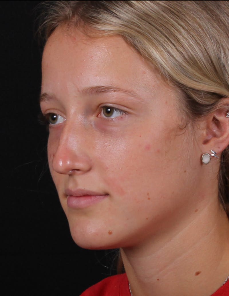 Rhinoplasty Female Before & After Gallery - Patient 938462 - Image 9