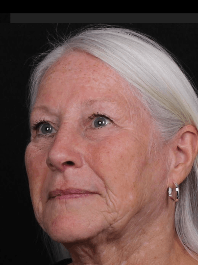 Rhinoplasty Female Before & After Gallery - Patient 289399 - Image 6