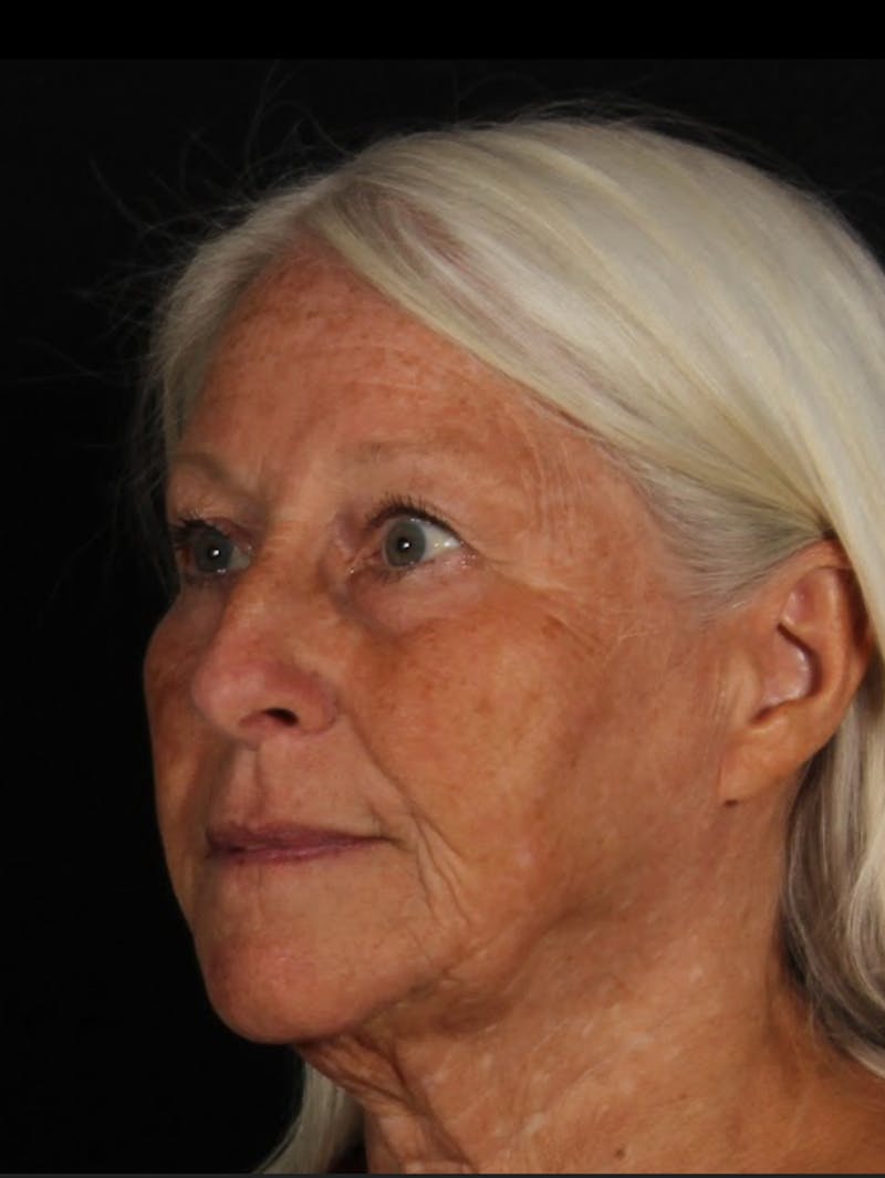 Rhinoplasty Female Before & After Gallery - Patient 289399 - Image 5