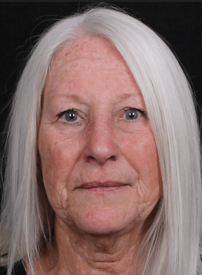 Rhinoplasty Female Before & After Gallery - Patient 289399 - Image 4