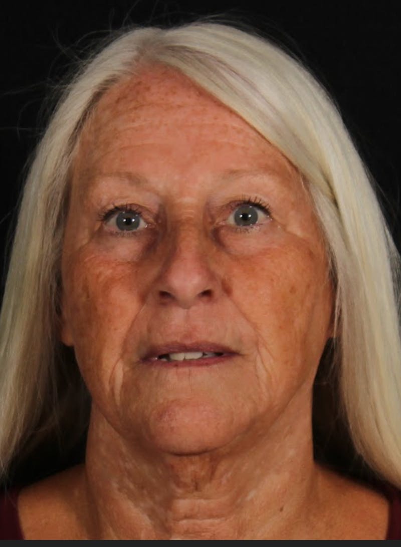 Rhinoplasty Female Before & After Gallery - Patient 289399 - Image 3