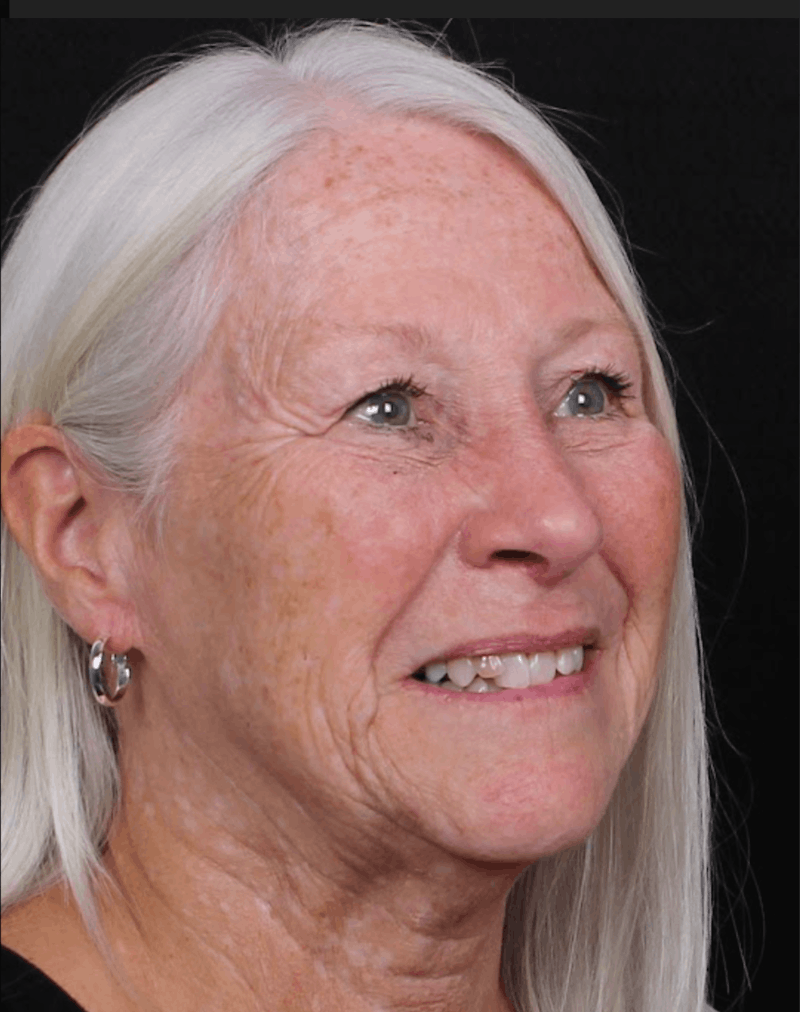 Rhinoplasty Female Before & After Gallery - Patient 289399 - Image 10