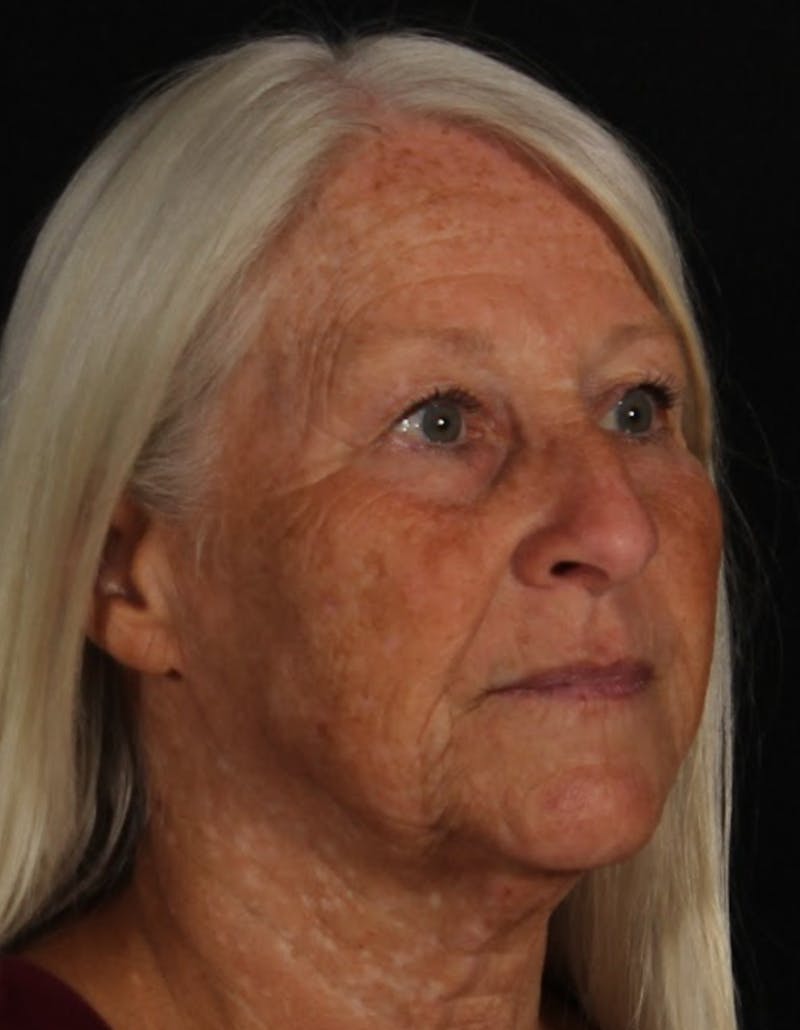 Rhinoplasty Female Before & After Gallery - Patient 289399 - Image 9