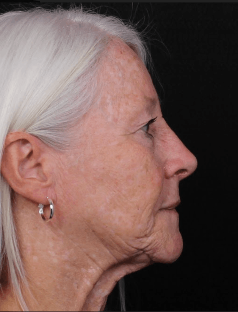 Rhinoplasty Female Before & After Gallery - Patient 289399 - Image 8