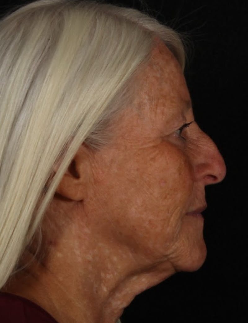 Rhinoplasty Female Before & After Gallery - Patient 289399 - Image 7
