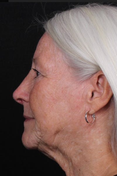 Rhinoplasty Female Before & After Gallery - Patient 289399 - Image 2