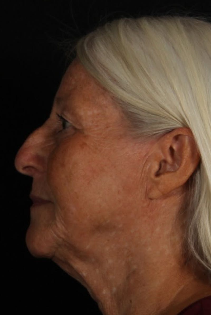 Rhinoplasty Female Before & After Gallery - Patient 289399 - Image 1