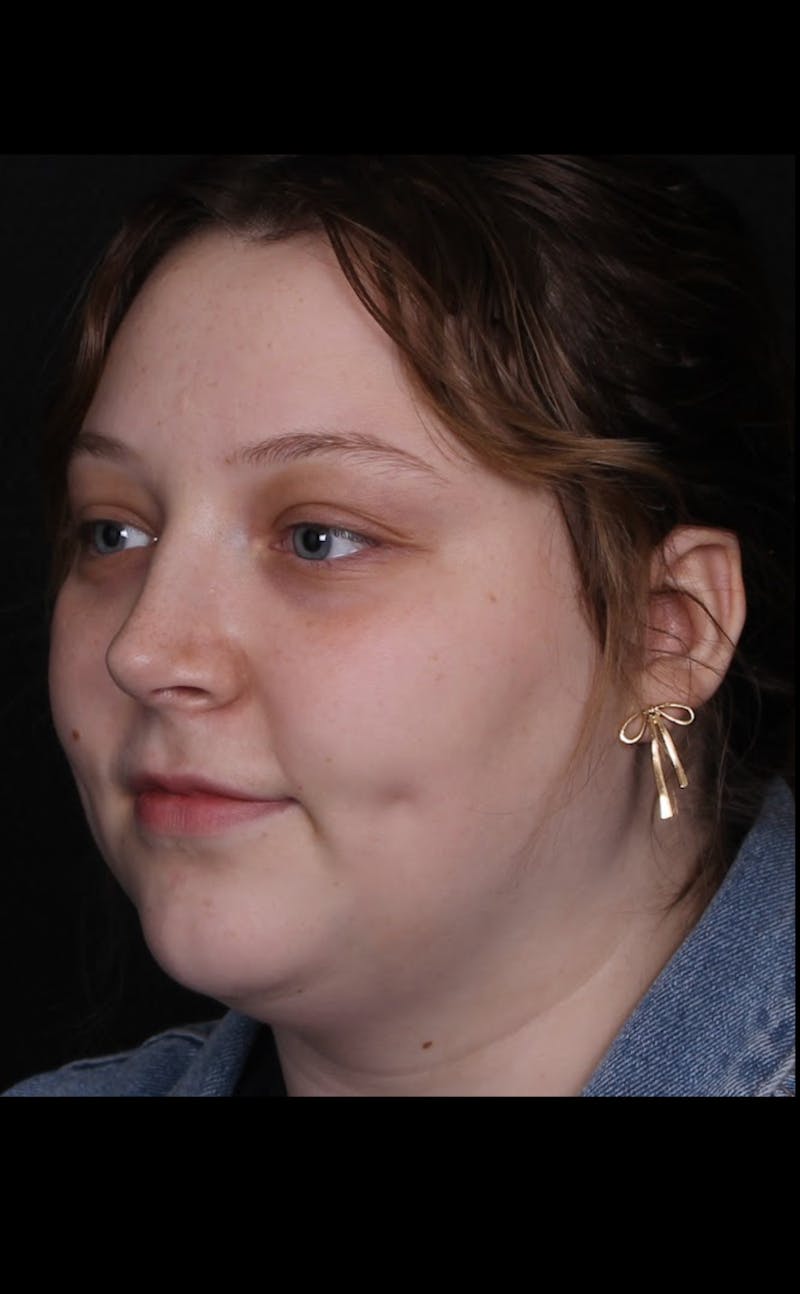 Rhinoplasty Female Before & After Gallery - Patient 113741 - Image 6