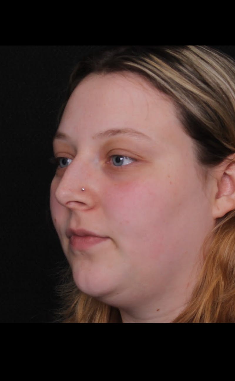 Rhinoplasty Female Before & After Gallery - Patient 113741 - Image 5