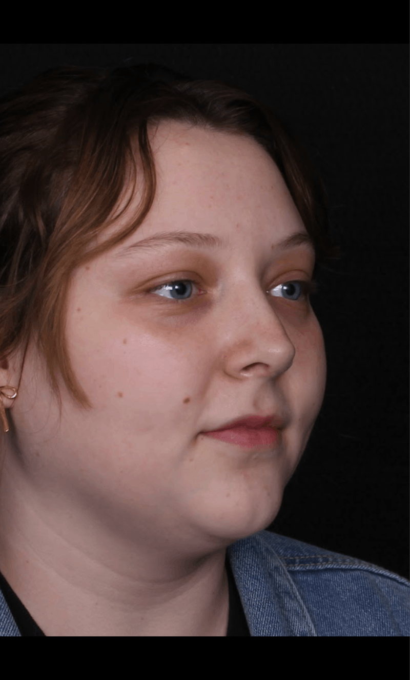 Rhinoplasty Female Before & After Gallery - Patient 113741 - Image 8