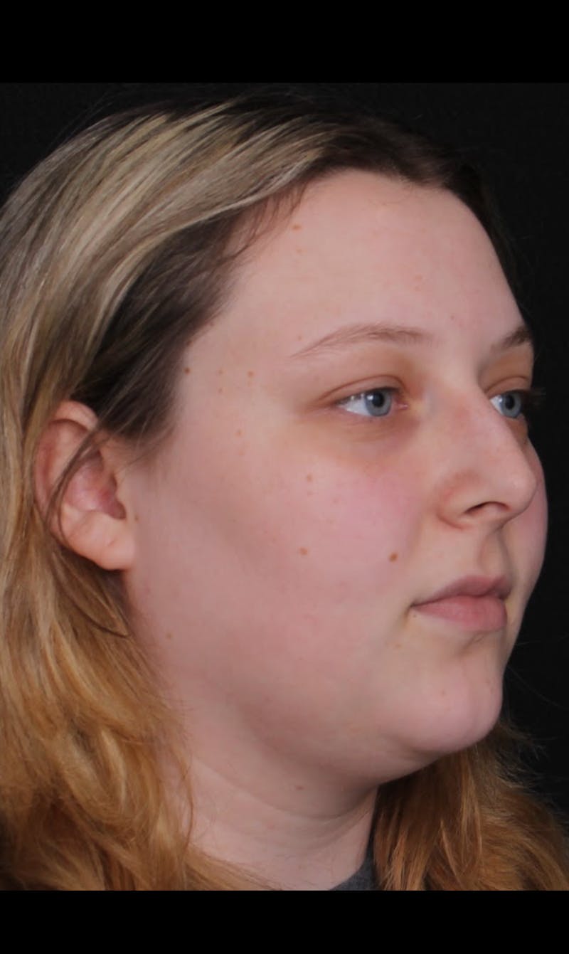 Rhinoplasty Female Before & After Gallery - Patient 113741 - Image 7