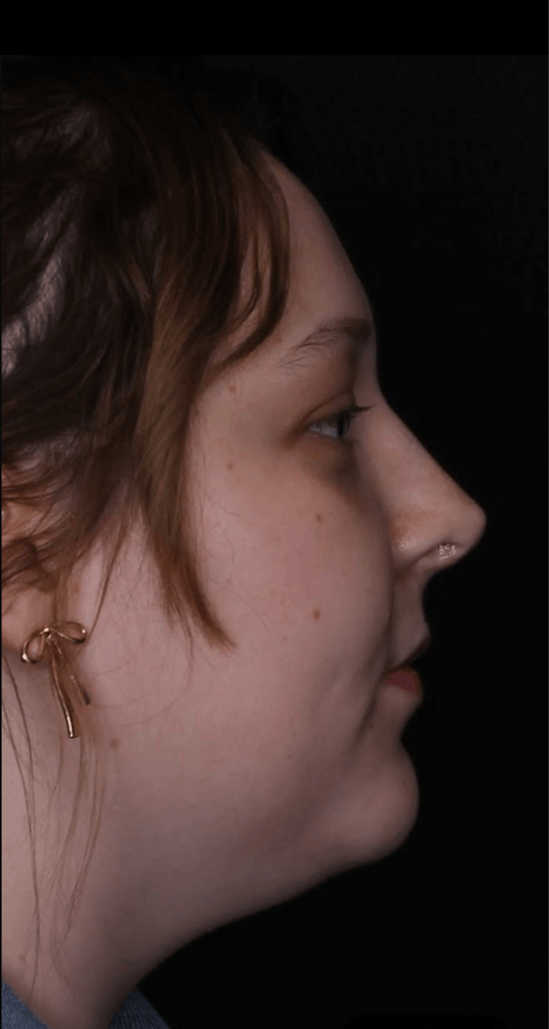 Rhinoplasty Female Before & After Gallery - Patient 113741 - Image 4
