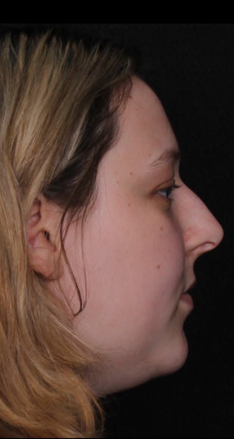 Rhinoplasty Female Before & After Gallery - Patient 113741 - Image 3