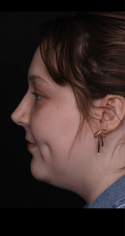 Rhinoplasty Female Before & After Gallery - Patient 113741 - Image 2