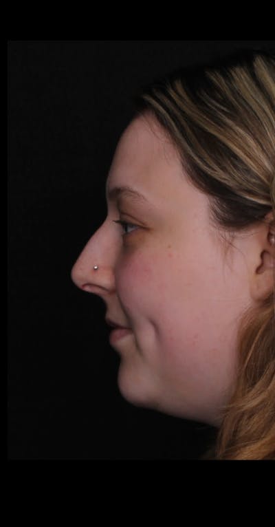 Rhinoplasty Female Before & After Gallery - Patient 113741 - Image 1