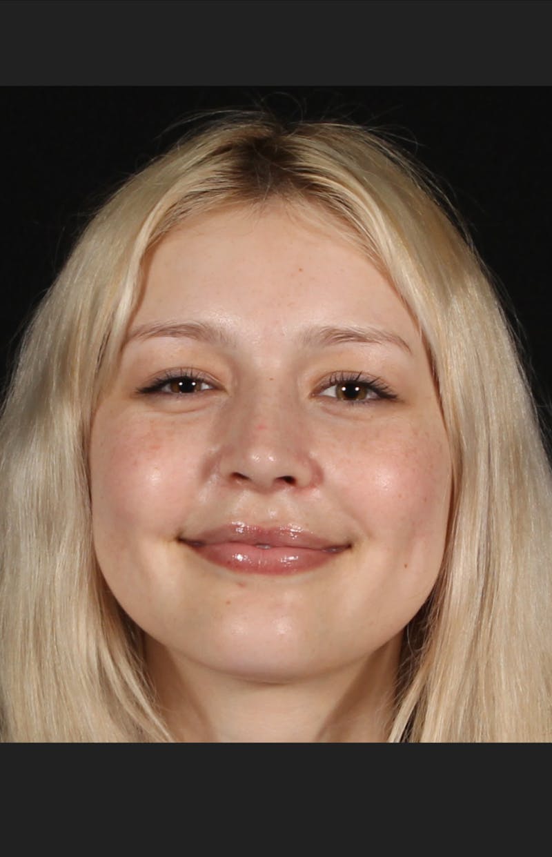 Rhinoplasty Female Before & After Gallery - Patient 109005 - Image 4