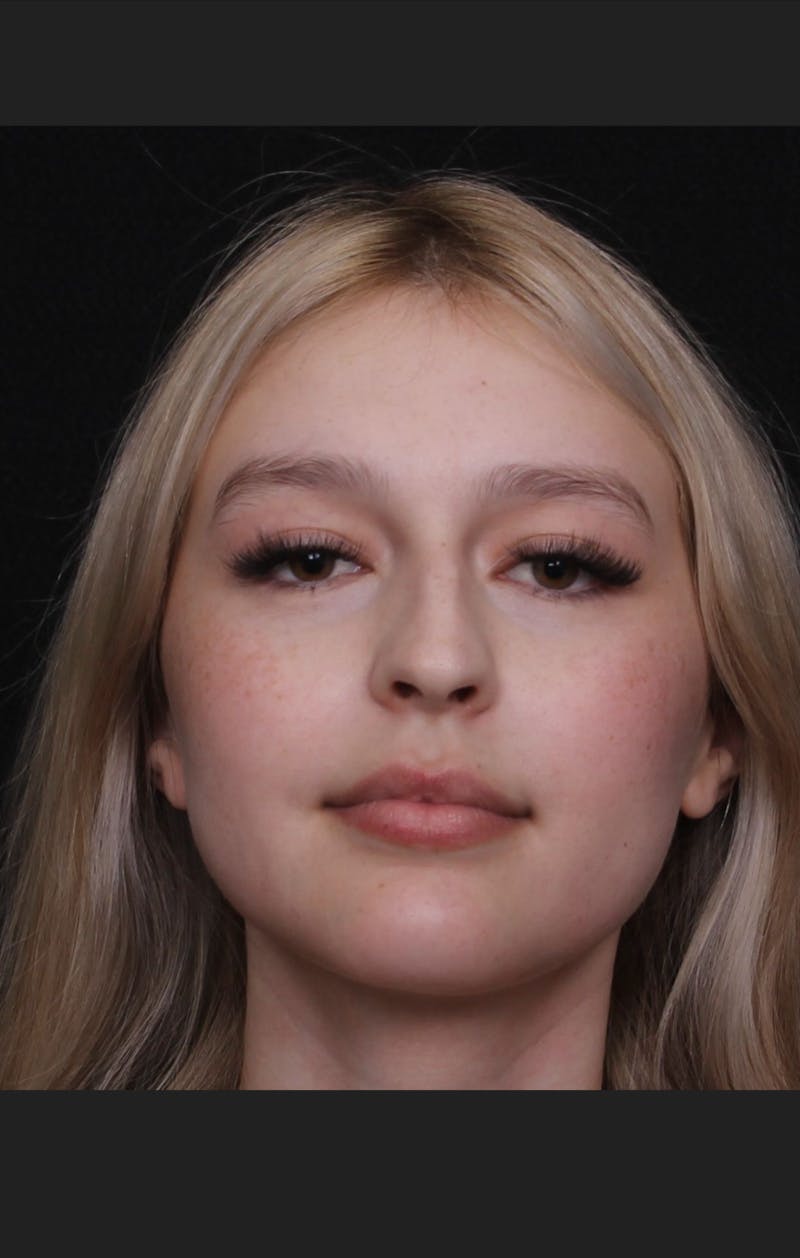 Rhinoplasty Female Before & After Gallery - Patient 109005 - Image 3