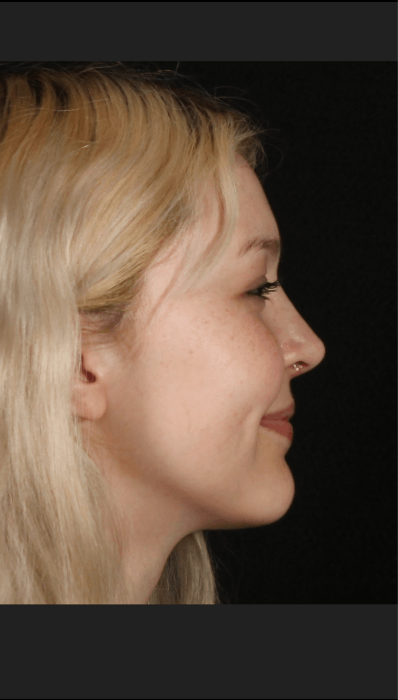 Rhinoplasty Female Before & After Gallery - Patient 109005 - Image 6