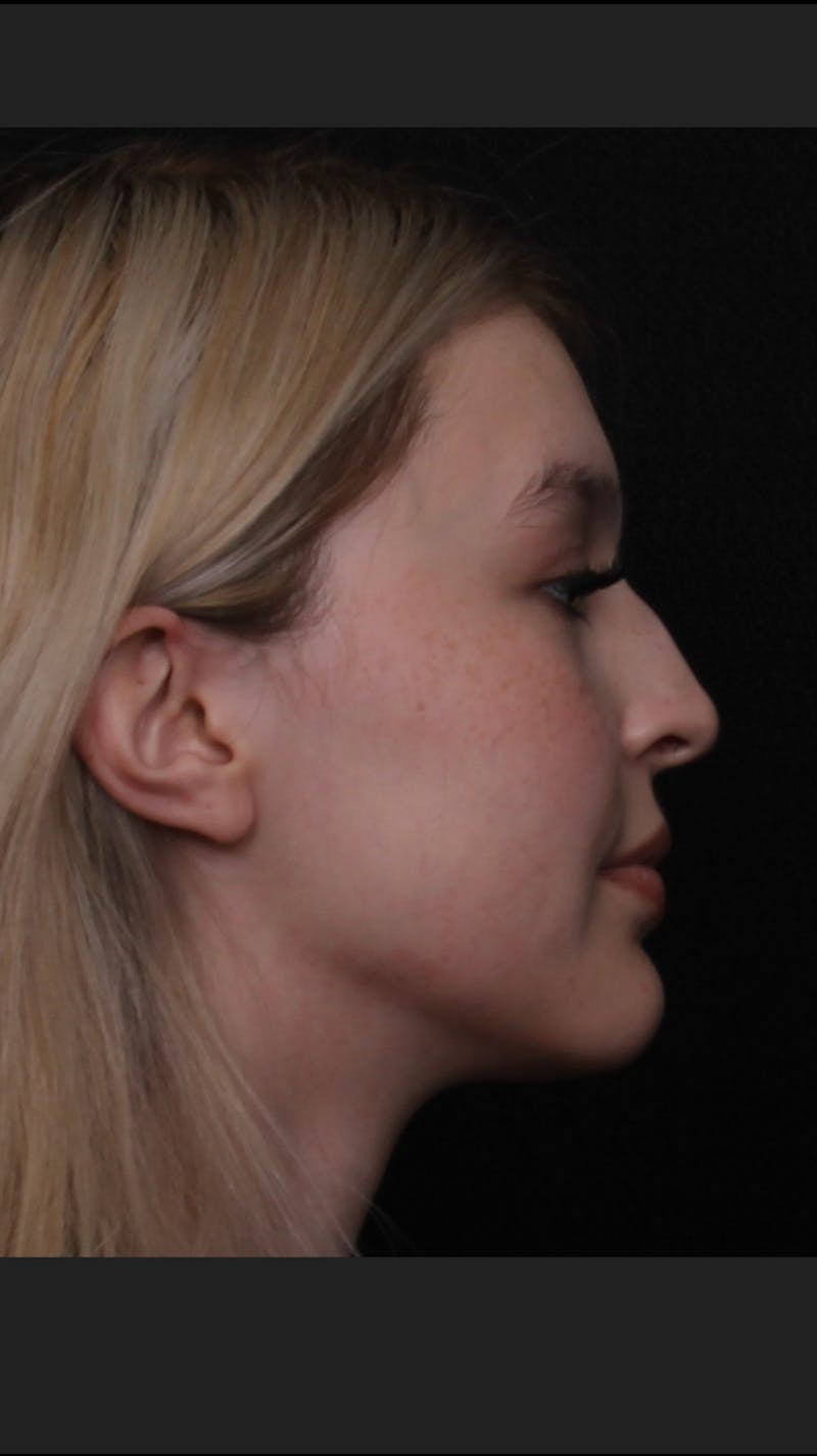 Rhinoplasty Female Before & After Gallery - Patient 109005 - Image 5