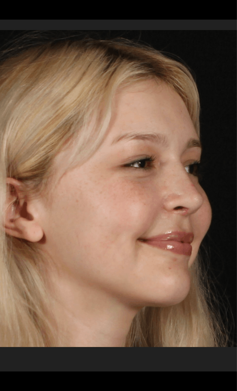 Rhinoplasty Female Before & After Gallery - Patient 109005 - Image 8
