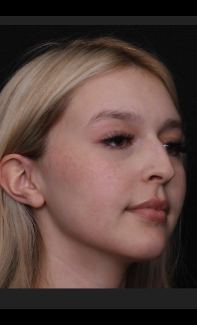 Rhinoplasty Female Before & After Gallery - Patient 109005 - Image 7