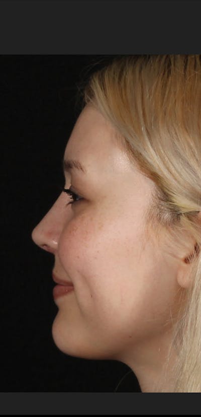 Rhinoplasty Female Before & After Gallery - Patient 109005 - Image 2