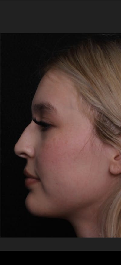 Rhinoplasty Female Before & After Gallery - Patient 109005 - Image 1