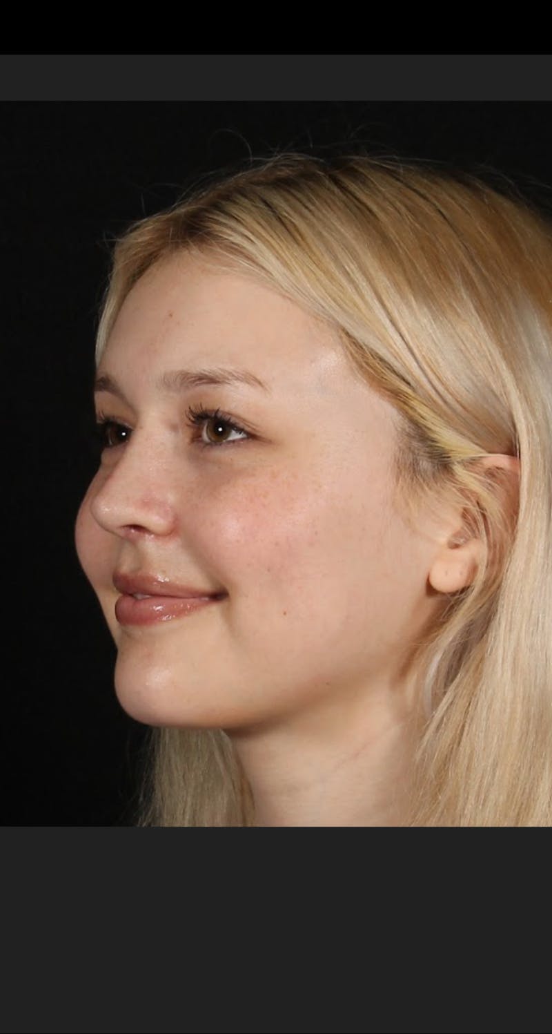 Rhinoplasty Female Before & After Gallery - Patient 109005 - Image 10