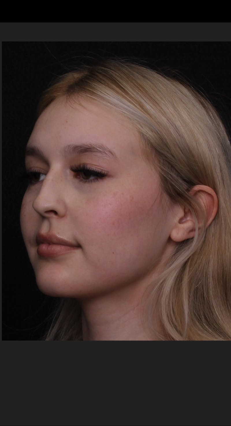 Rhinoplasty Female Before & After Gallery - Patient 109005 - Image 9